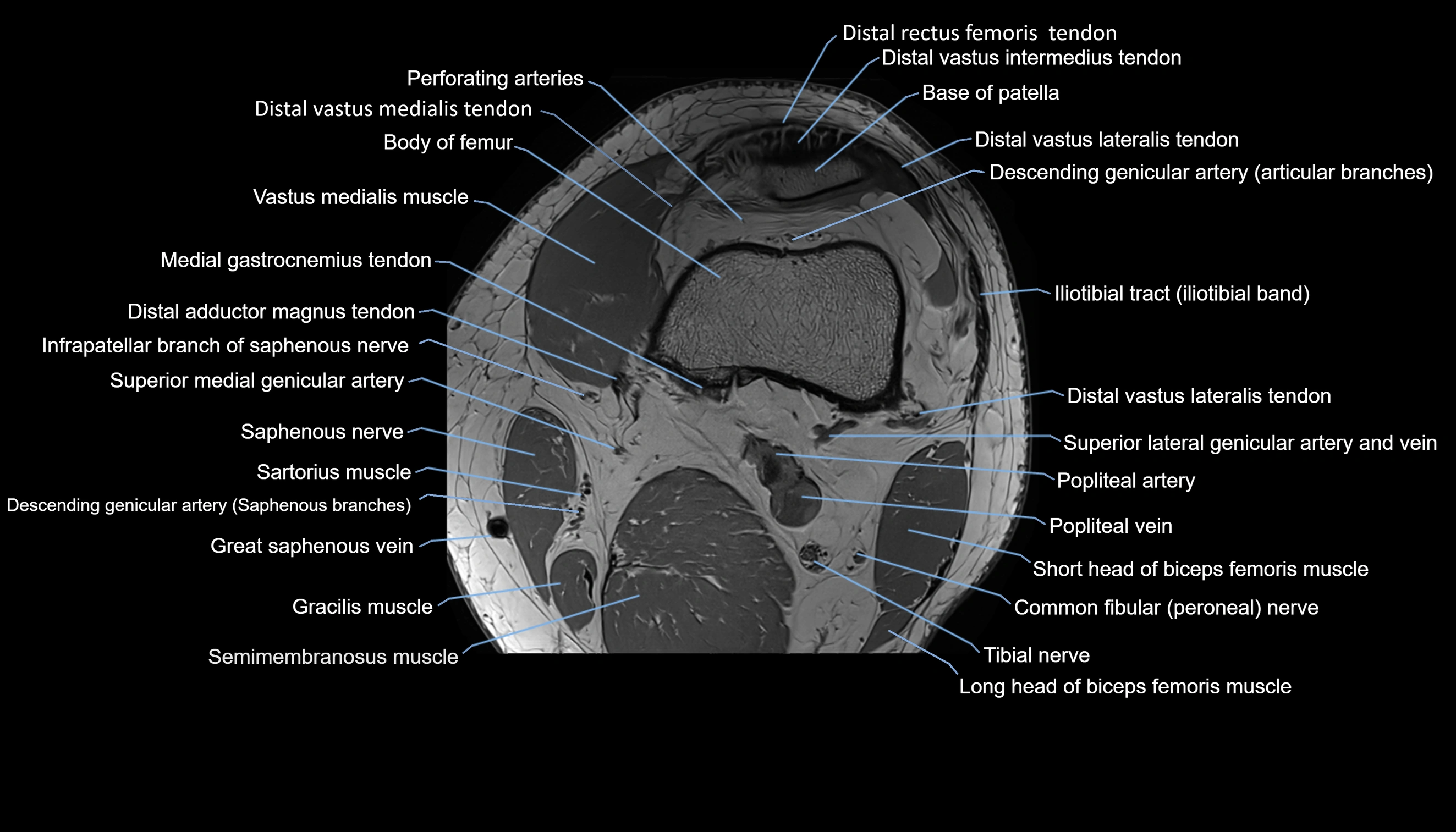 MRI knee  axial cross sectional anatomy 3T radiology  image-img-00001-00008.webp